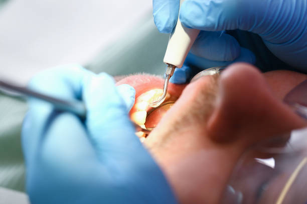 Best Emergency Dental Care for Broken or Chipped Teeth in Owensville, MO